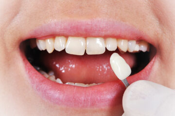 How To Fix A Broken Tooth With Veneers?