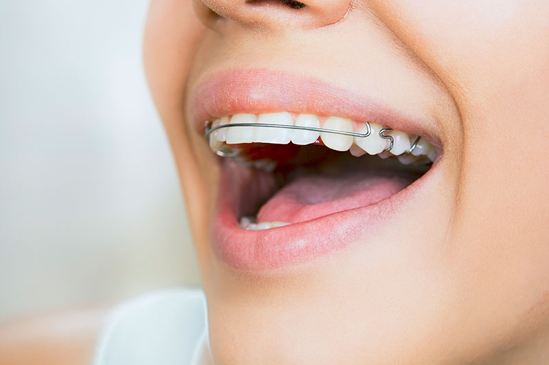 tooth retainer brooklin whitby on dental
