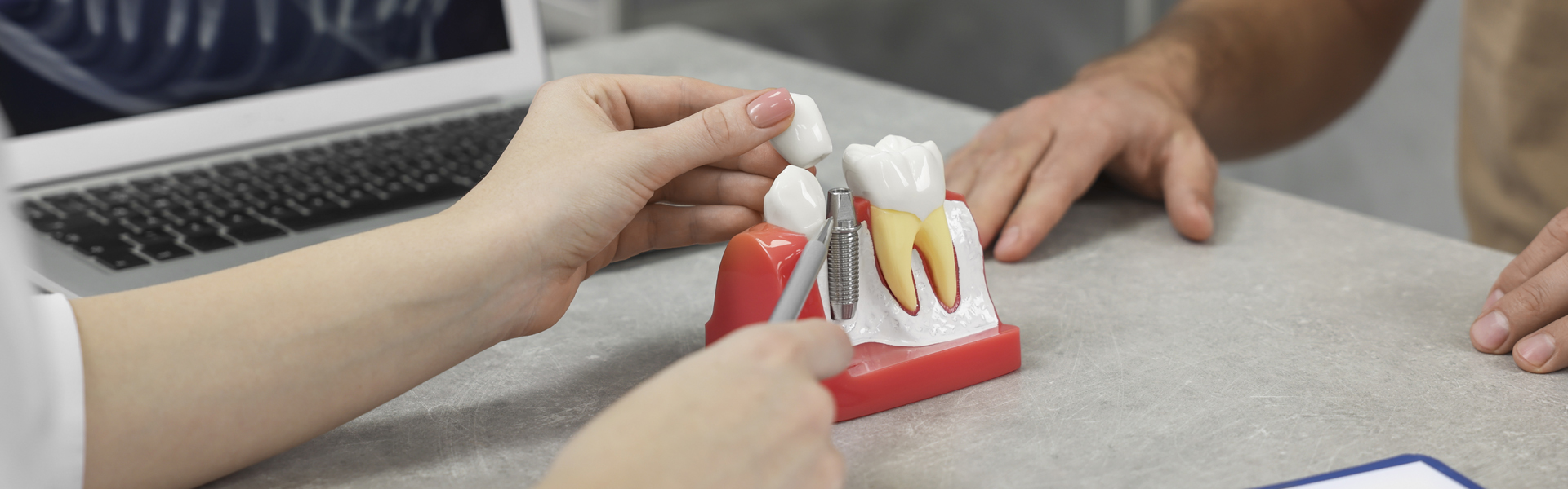 Whitby dentists explaining dental implants and bone grafting using a model of it.